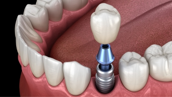 Illustrated dental crown being placed onto a dental implant