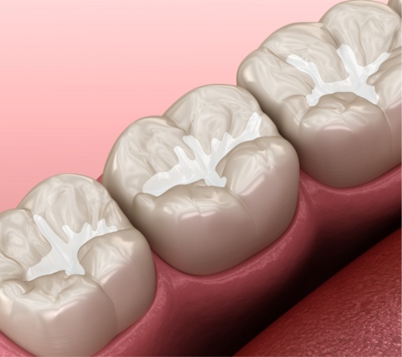 Illustrated row of teeth with dental sealants