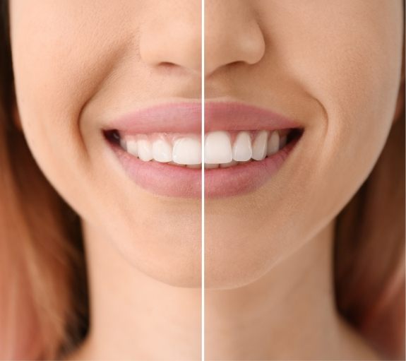 Close up of smile before and after fixing gummy smile