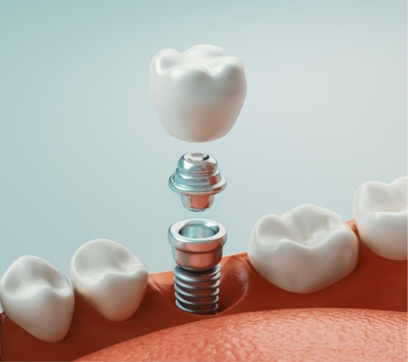 Illustrated dental implant with dental crown and abutment
