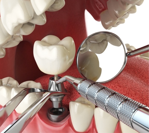 Illustrated dental implant being placed in lower jaw