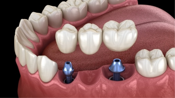 Illustrated dental bridge being placed onto two dental implants