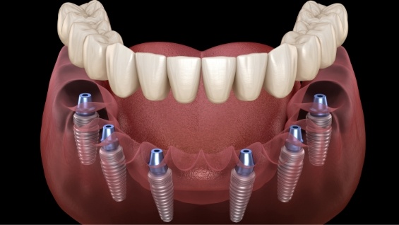 Illustrated denture being placed onto six dental implants