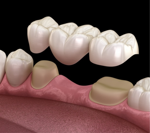 Illustrated dental bridge replacing a missing tooth