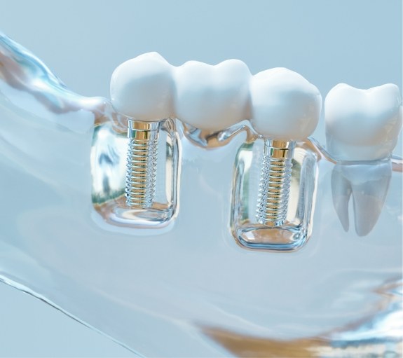 Model of mouth with two dental implants replacing missing teeth