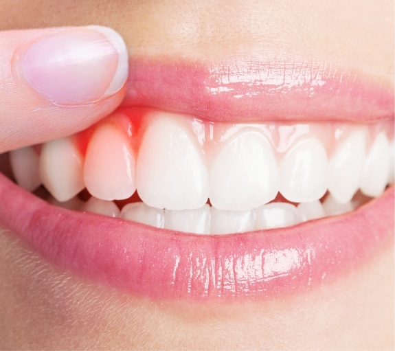 Close up of person pointing to red spot in their gums