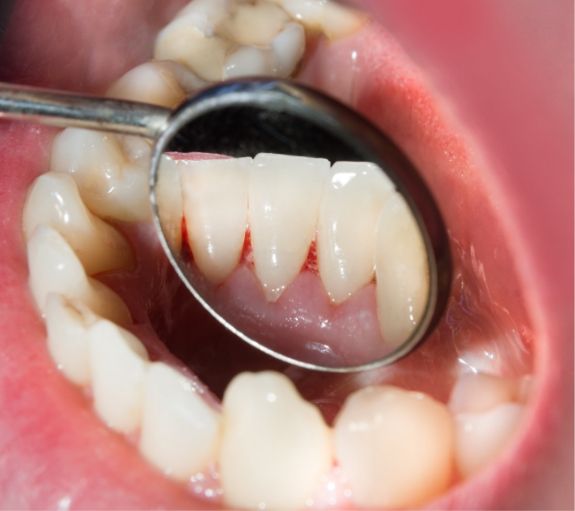 Close up of dental mirror inside of mouth