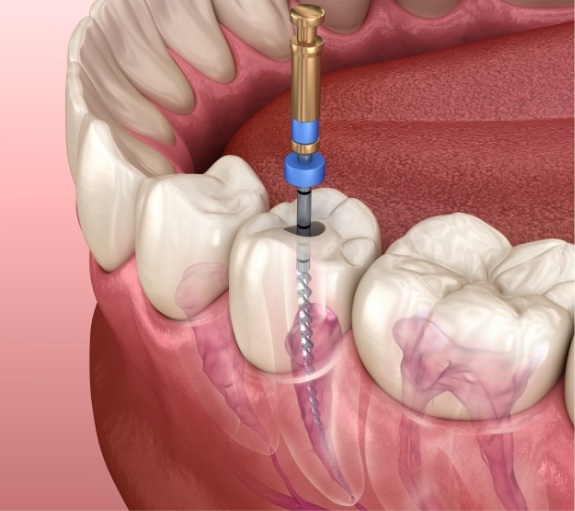Illustrated dental instrument cleaning inside of tooth