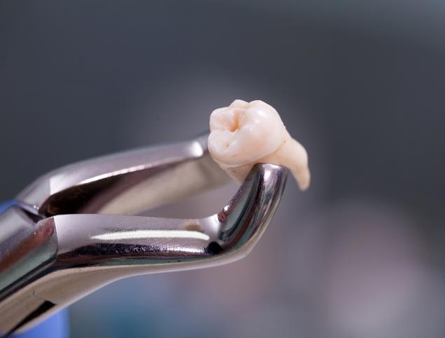 Dental forceps holding an extracted tooth in Topsham