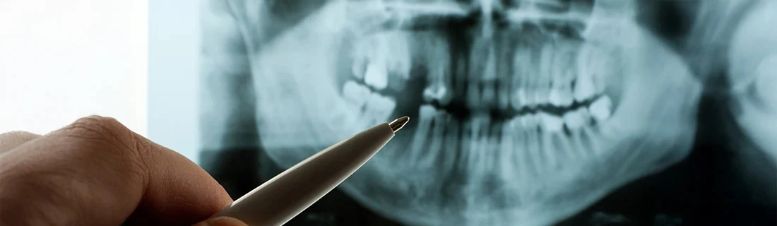Dentist Topsham ME Doctor Pointing To Missing Tooth X-Ray Dental Technology Doctor Pointing To Missing Tooth X-Ray Dental Technology