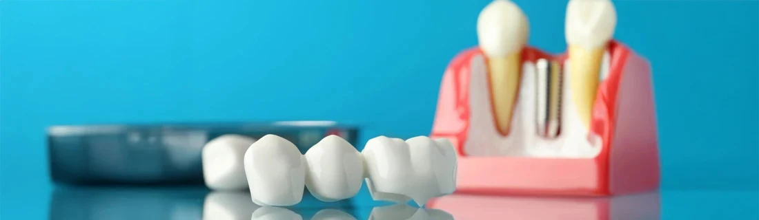 Various Methods of Replacing Teeth are Shown Missing Teeth